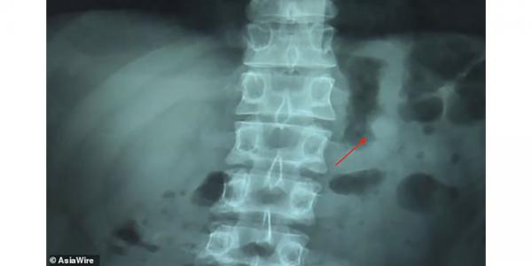 photo of Accidentally swallowed AirPod still worked, even in a man’s stomach … ‘magical,’ says owner image